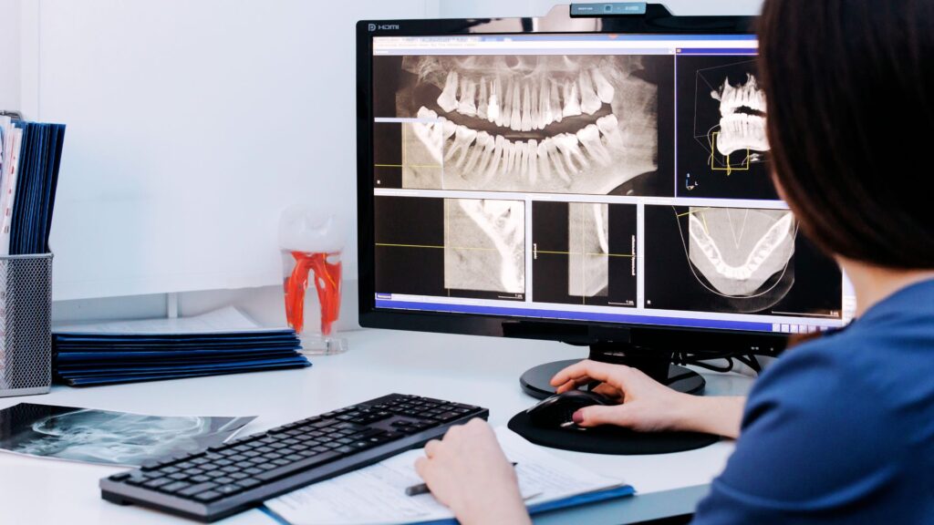 Radiographie dentaire affichée sur un écran d’ordinateur, montrant les dents de sagesse